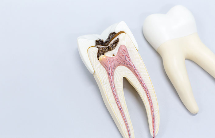 Tratamiento de la caries