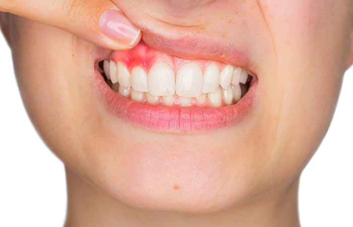 Tratamiento de periodoncia