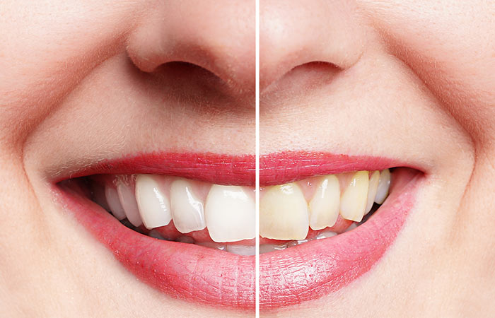 Tratamientos de estética dental