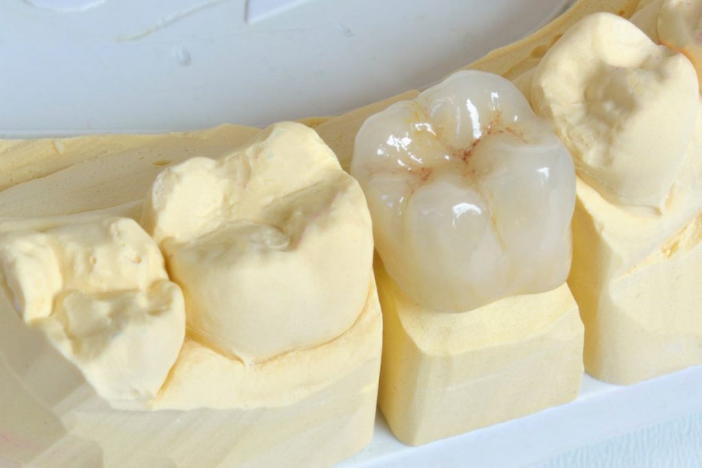 Corona dental