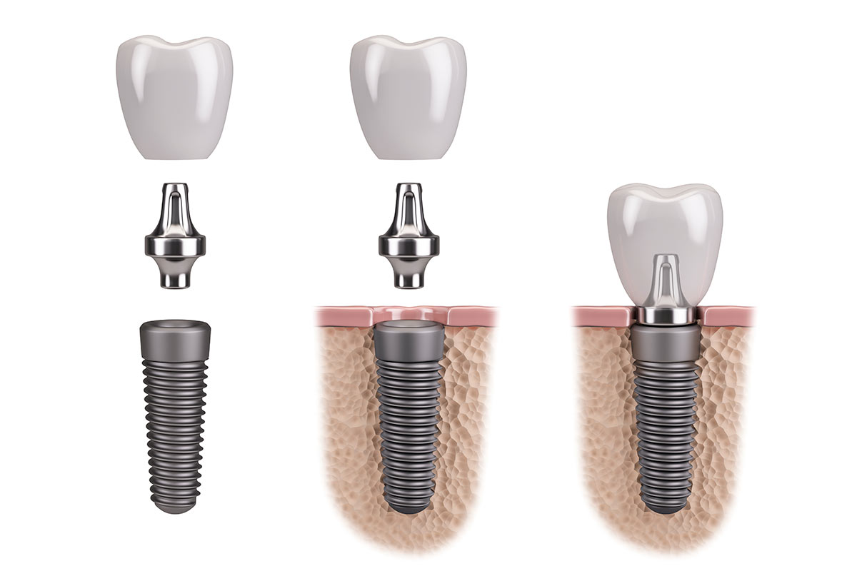 Partes de un implante dental