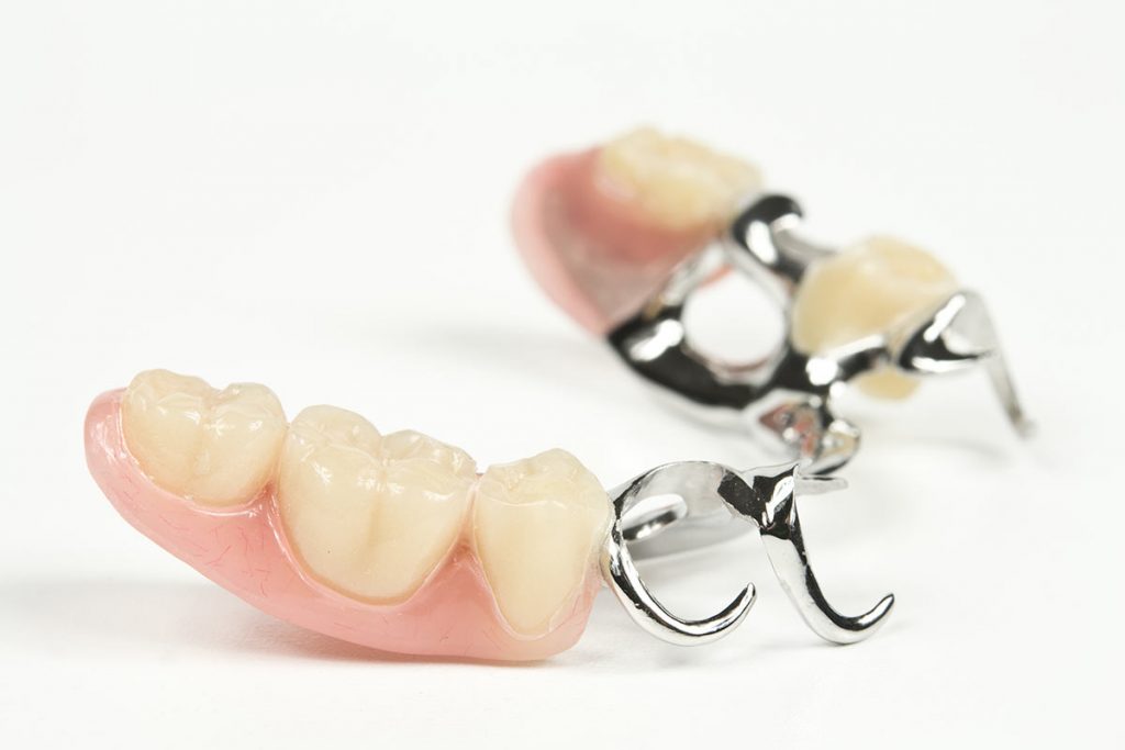 Puentes dentales