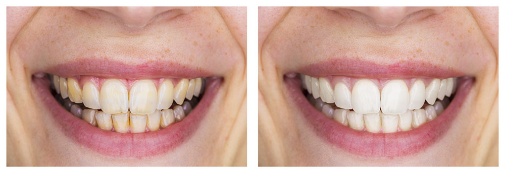 Efectos del blanqueamiento dental en Torremolinos