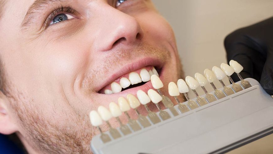 Blanqueamiento dental, todo lo que debes saber