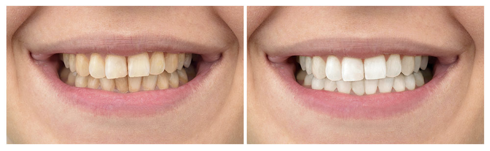 Los resultados del blanqueamiento dental