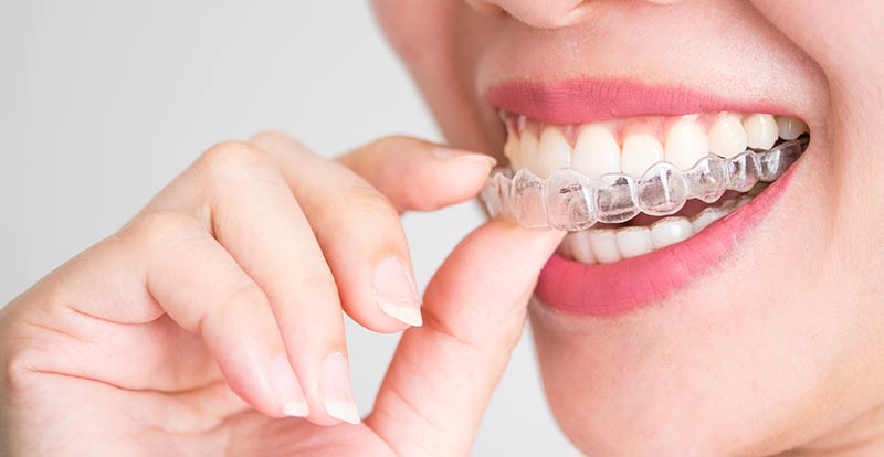 Paciente con Invisalign