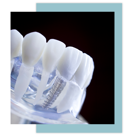 Implantes dentales en Torremolinos, clínica dental Martínez Avilés. Implantes dentales en Torremolinos, clínica dental Martínez Avilés.
