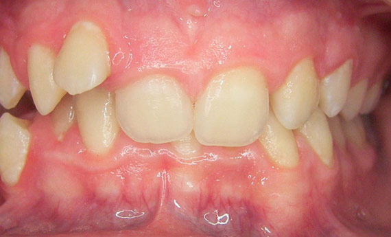 Caso de ortodoncia por apiñamiento dental, antes de.