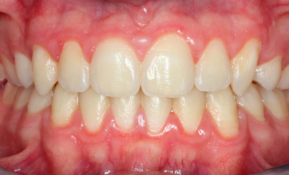 Caso de ortodoncia por apiñamiento dental, después de.
