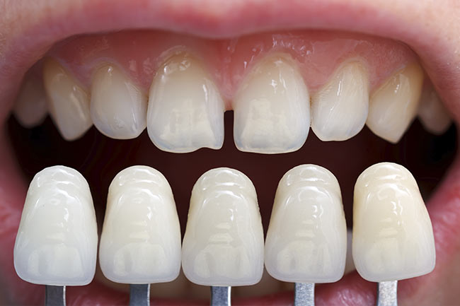 Forma de las carillas dentales