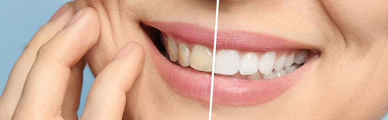 Resultados del blanqueamiento dental