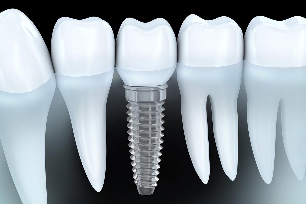 Colocación implantes dentales Colocación implantes dentales