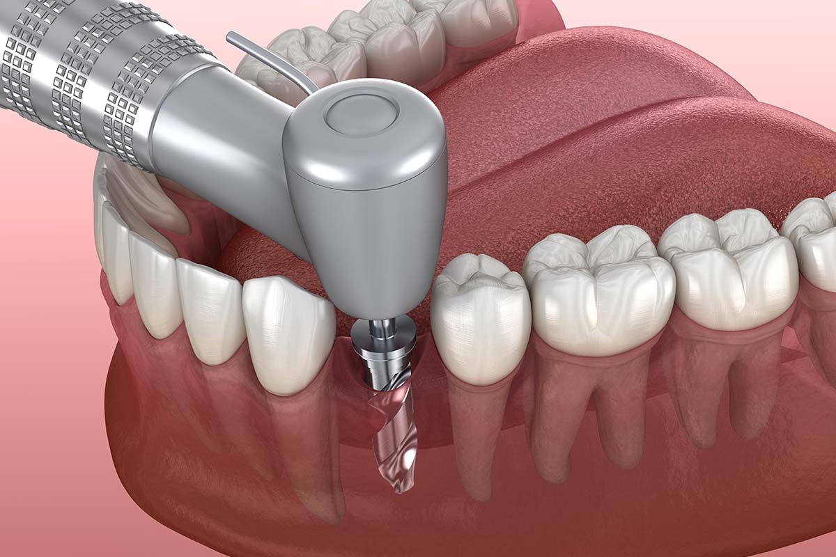 Oseointegración implantes dentales Oseointegración implantes dentales