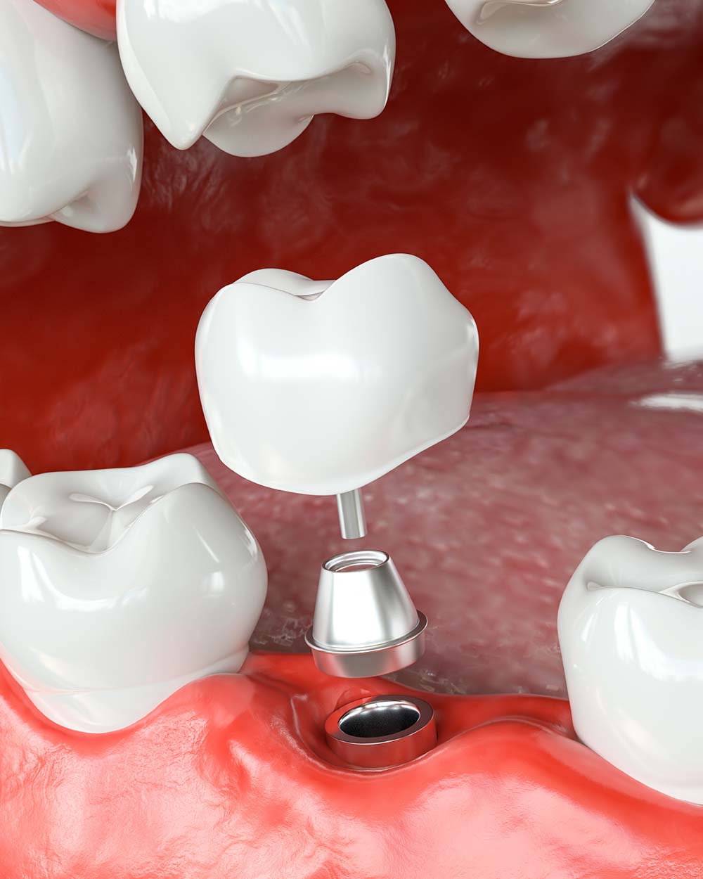 IMPLANTES INMEDIATOS EN TORREMOLINOS