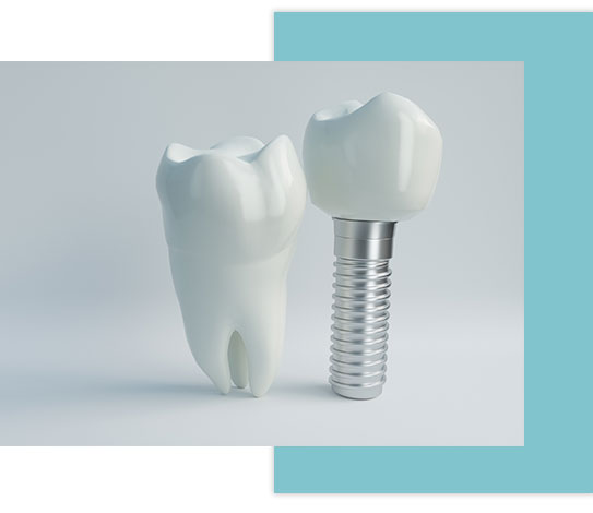preguntas-frecuentes-implantes-dentales preguntas-frecuentes-implantes