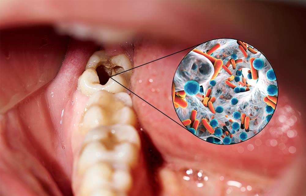 Qué son las caries y cómo se forman