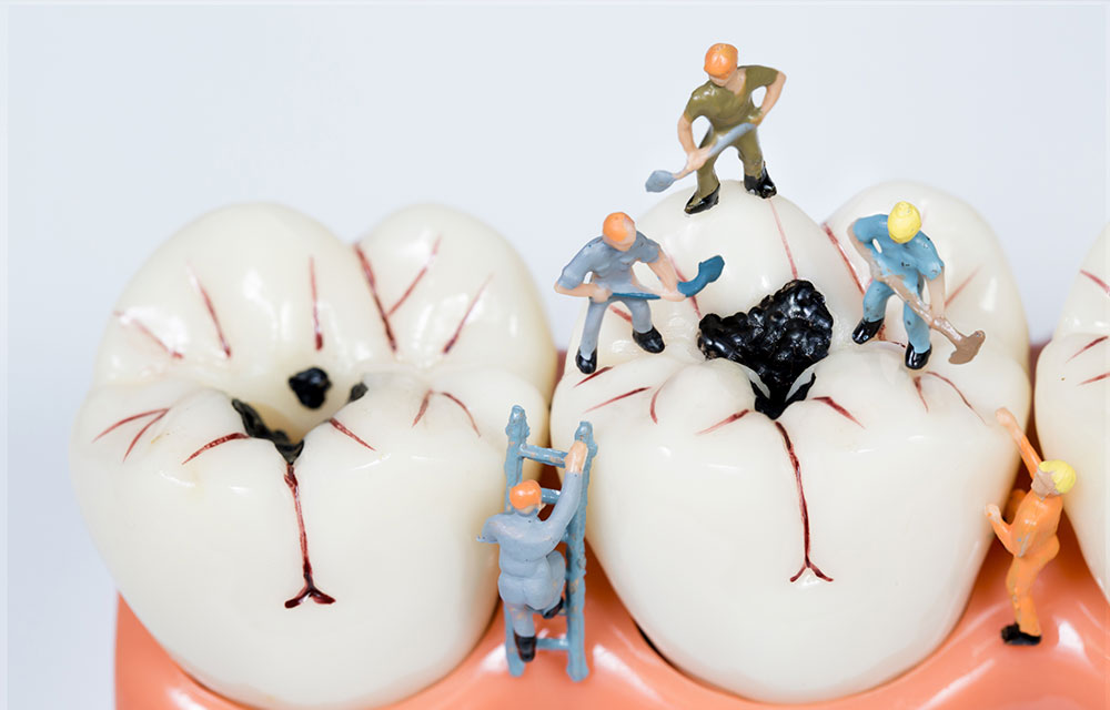 Tratamiento de una caries en Torremolinos