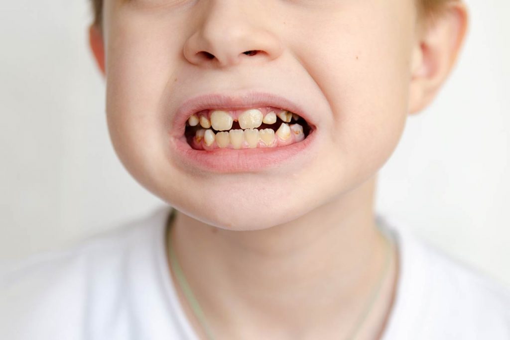 Motivos dientes amarillos en niños