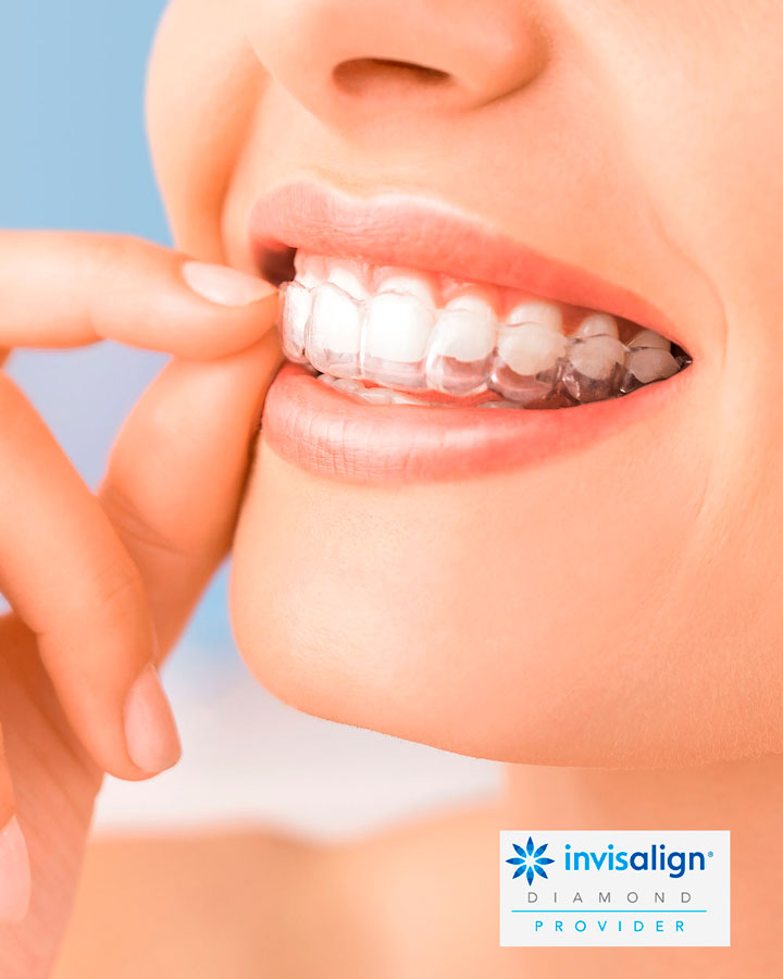 invisalign ortodoncia