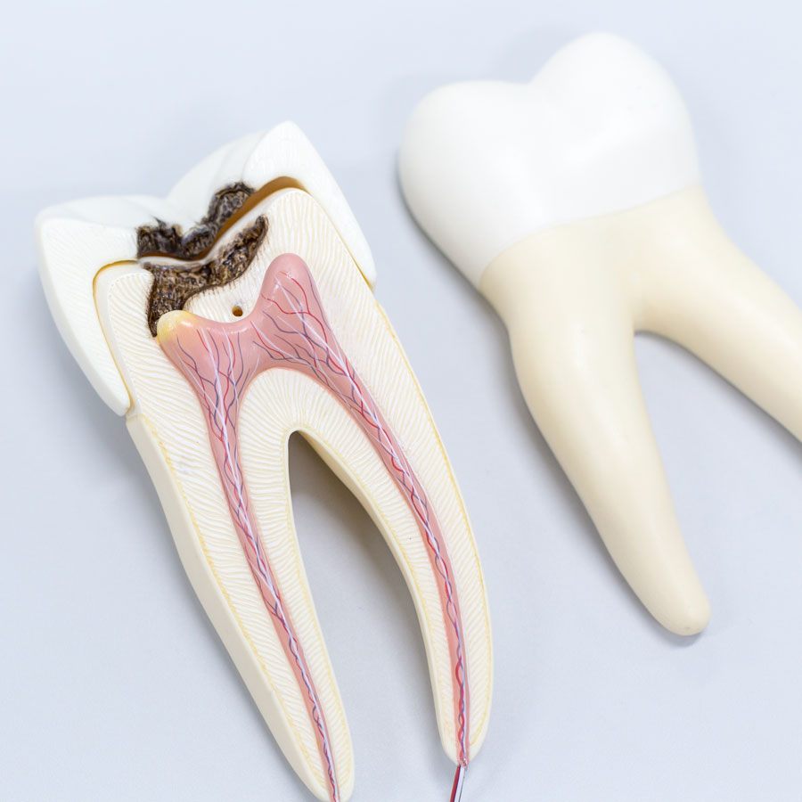maqueta muela con caries