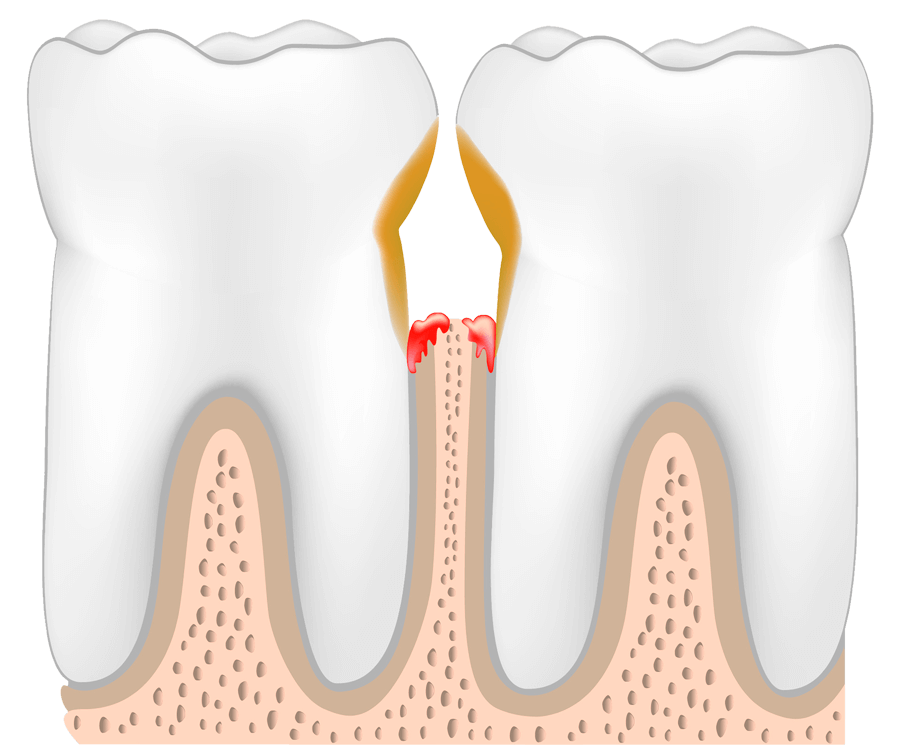 gingivitis periodoncia