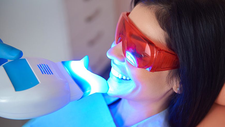 ¿Cuánto dura un blanqueamiento dental?