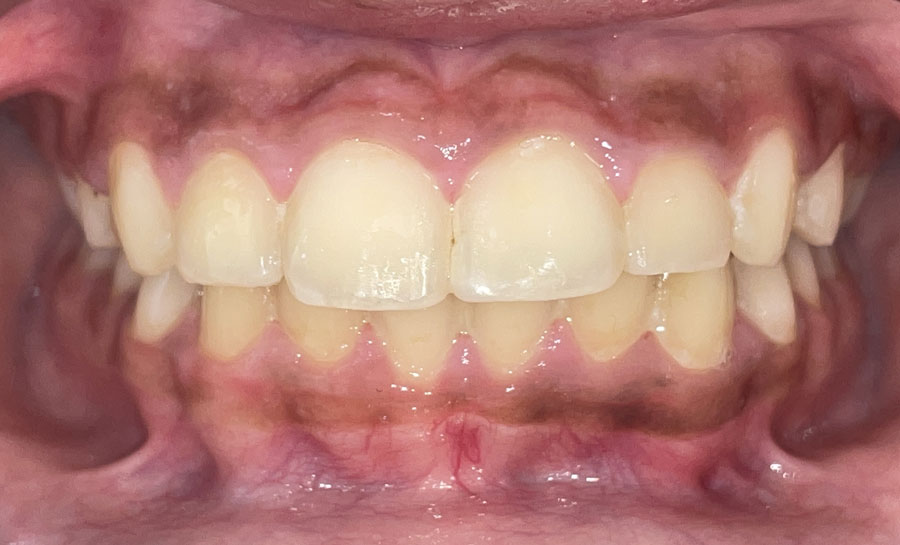 After image