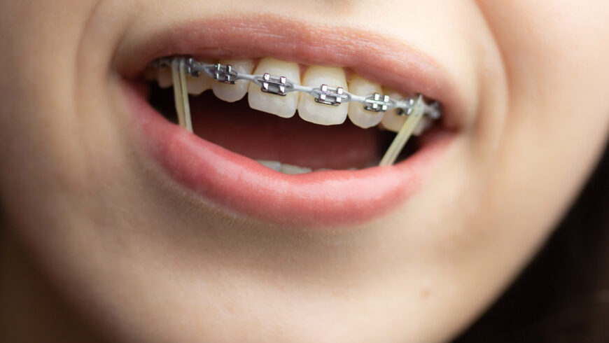 ¿Para qué sirven las gomas de los brackets?