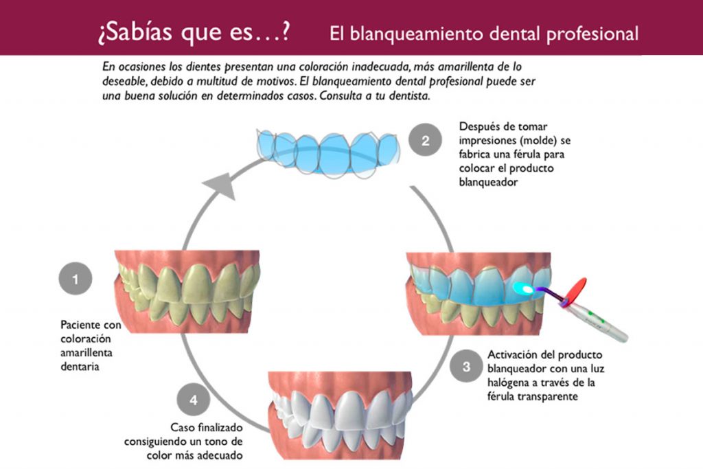Qué es un blanqueamiento dental.