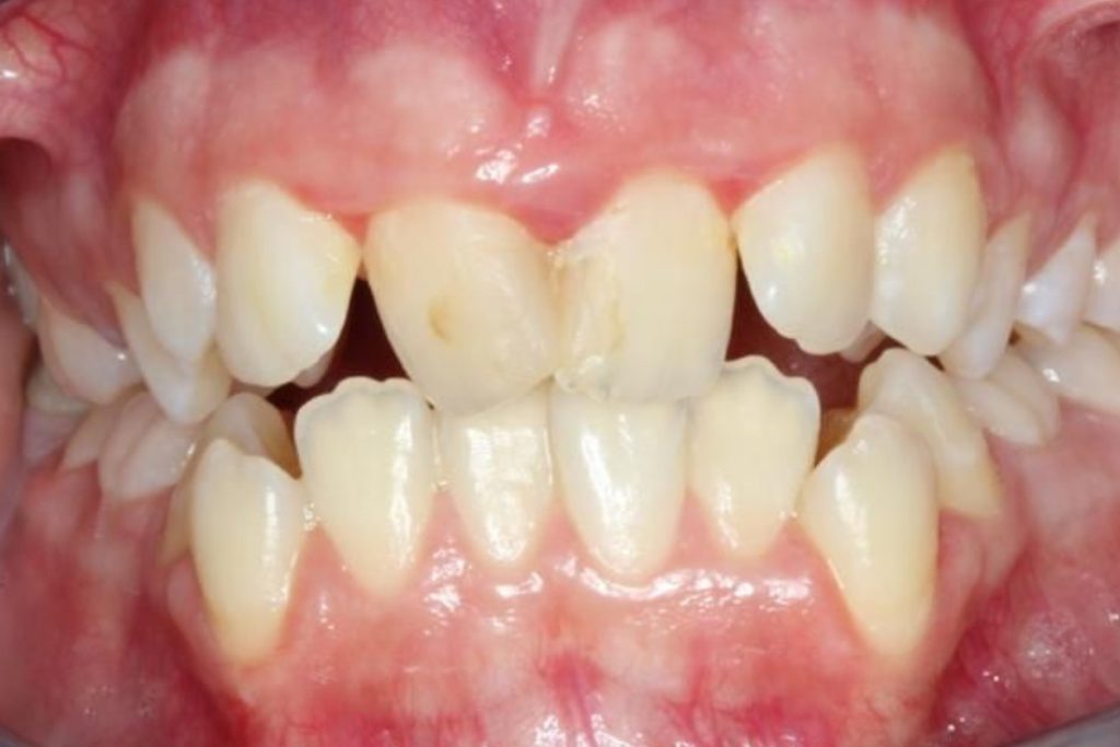 Estado incial dental en adulto.