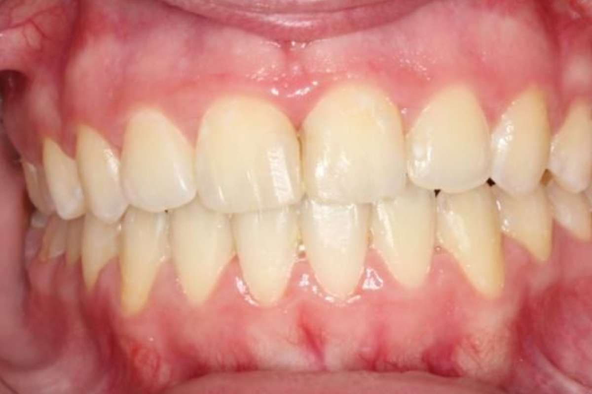 Caso real de alineación dental por Invisalign en adulto.