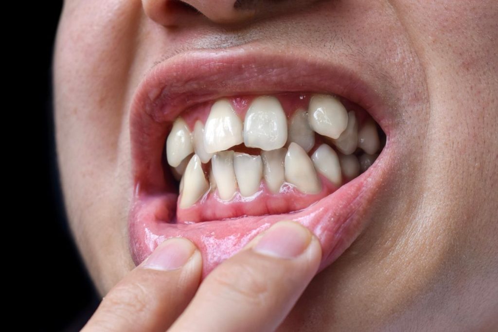 Apiñamiento dental