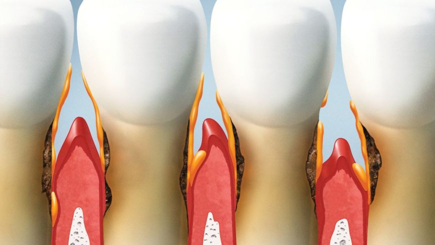 Triángulos negros en dientes, ¿qué son?
