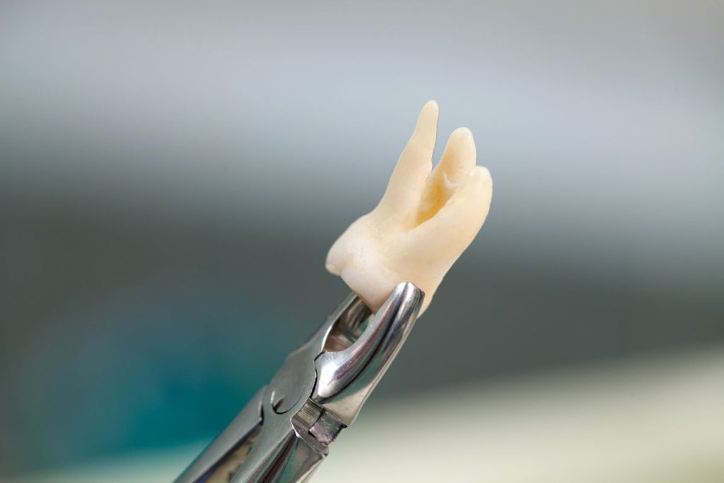 Perdida dentales en la tercera edad.