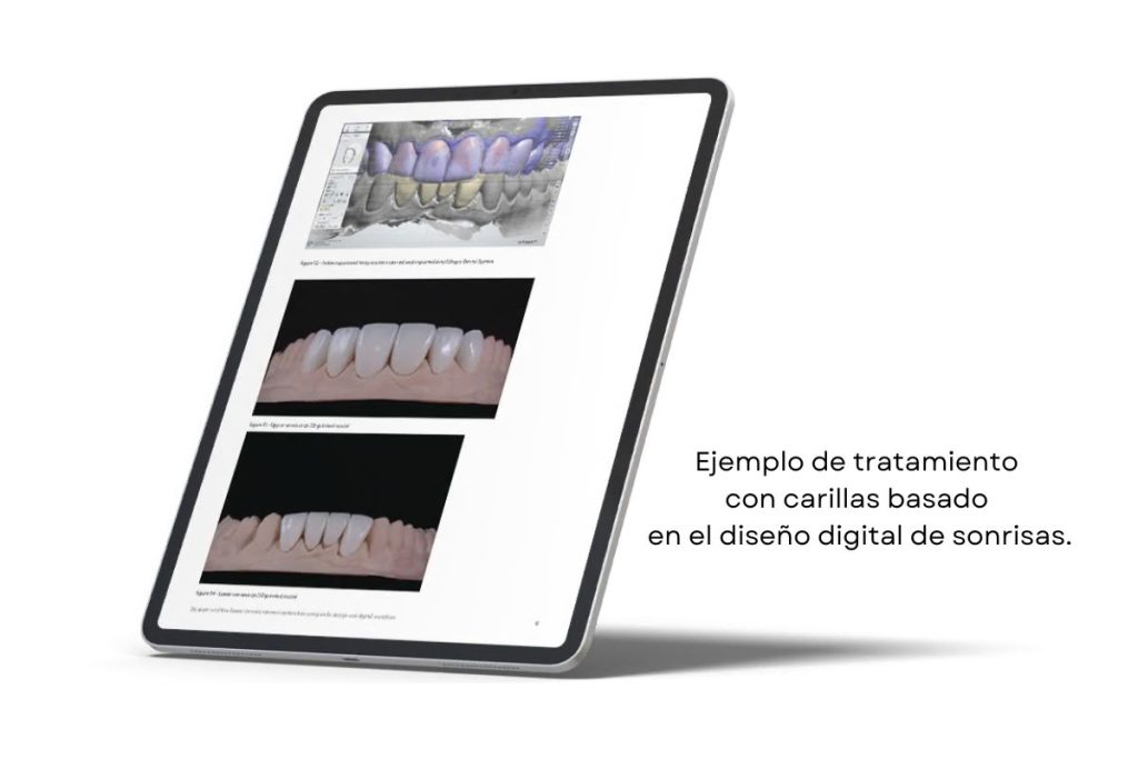 Proyección de tratamiento con carillas basado en el diseño digital 3D.