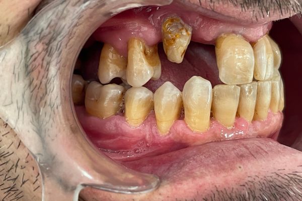Situación del caso 233. Foto intraoral derecha.
