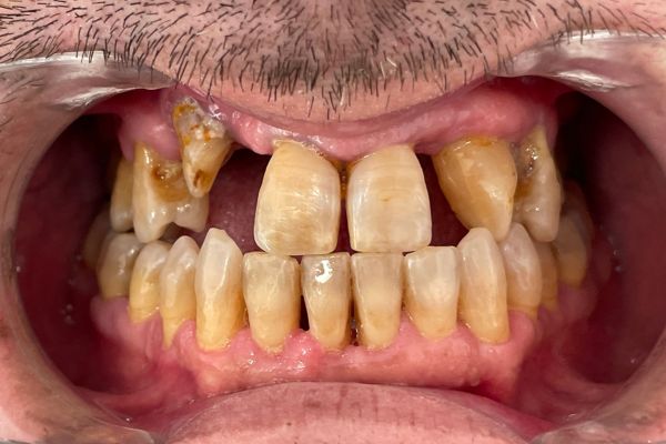 Situación del caso 233. Foto intraoral forntal.