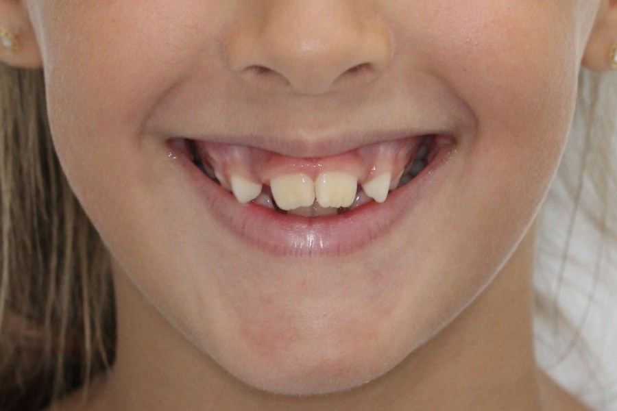Aspecto de compresión mandibular severa en niña de 8 años.