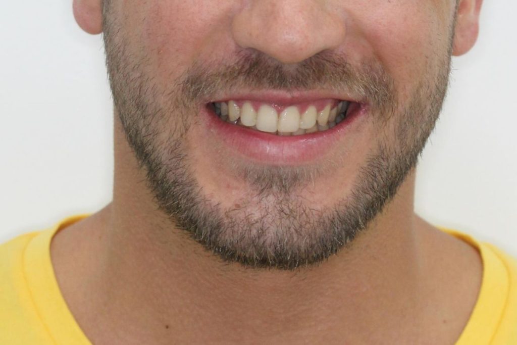 Resultado final de ortodoncia y carillas en incisivos en Torremolinos.