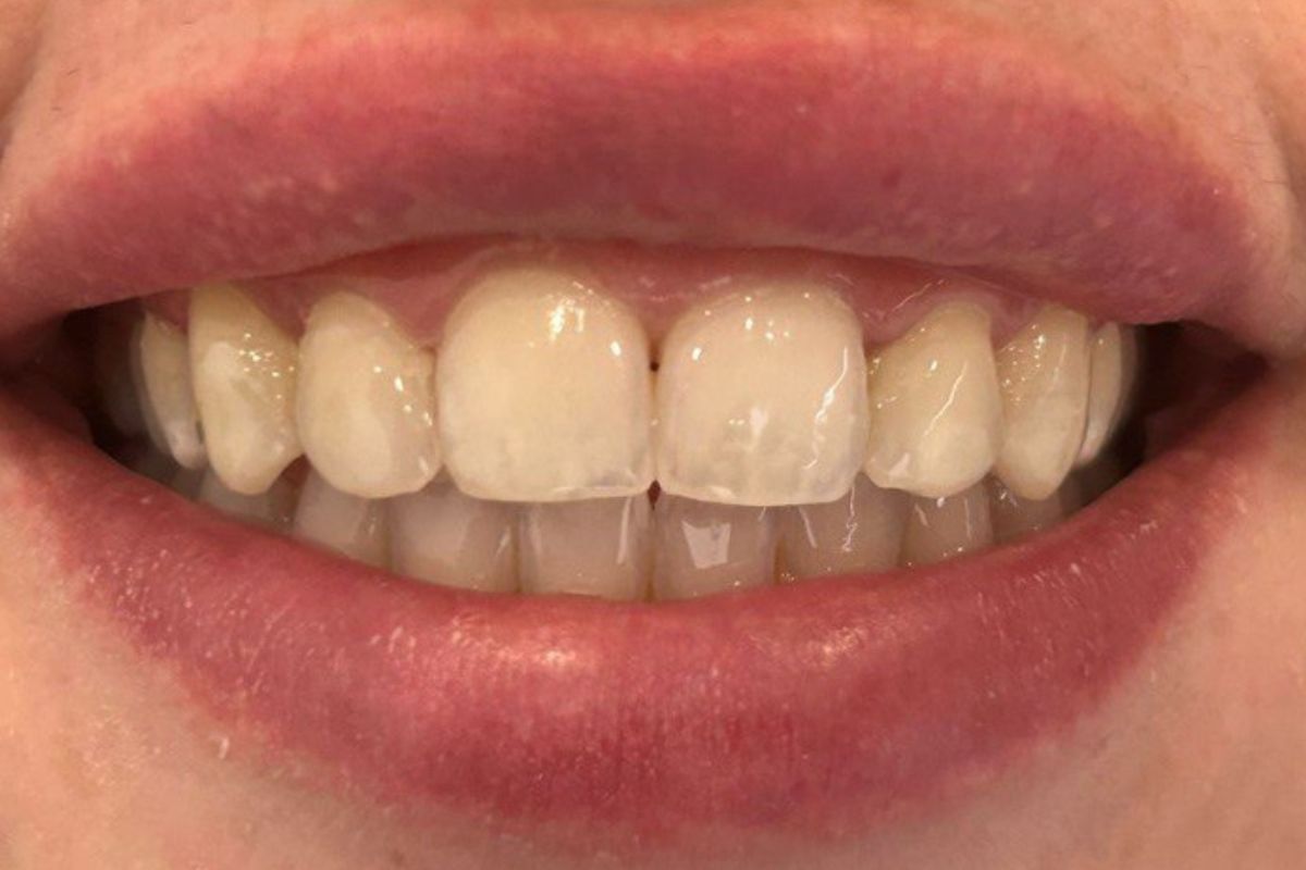 Resultado final del tratamiento de manchas blancas en dientes, Torremolinos.