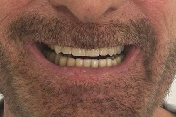 Tratamiento dental integral en 6 meses, Torremolinos. Después.